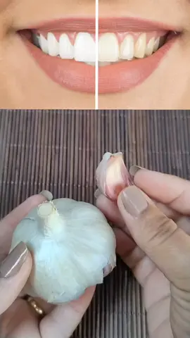 Dentes amarelados nunca mais, com essa potente mistura 