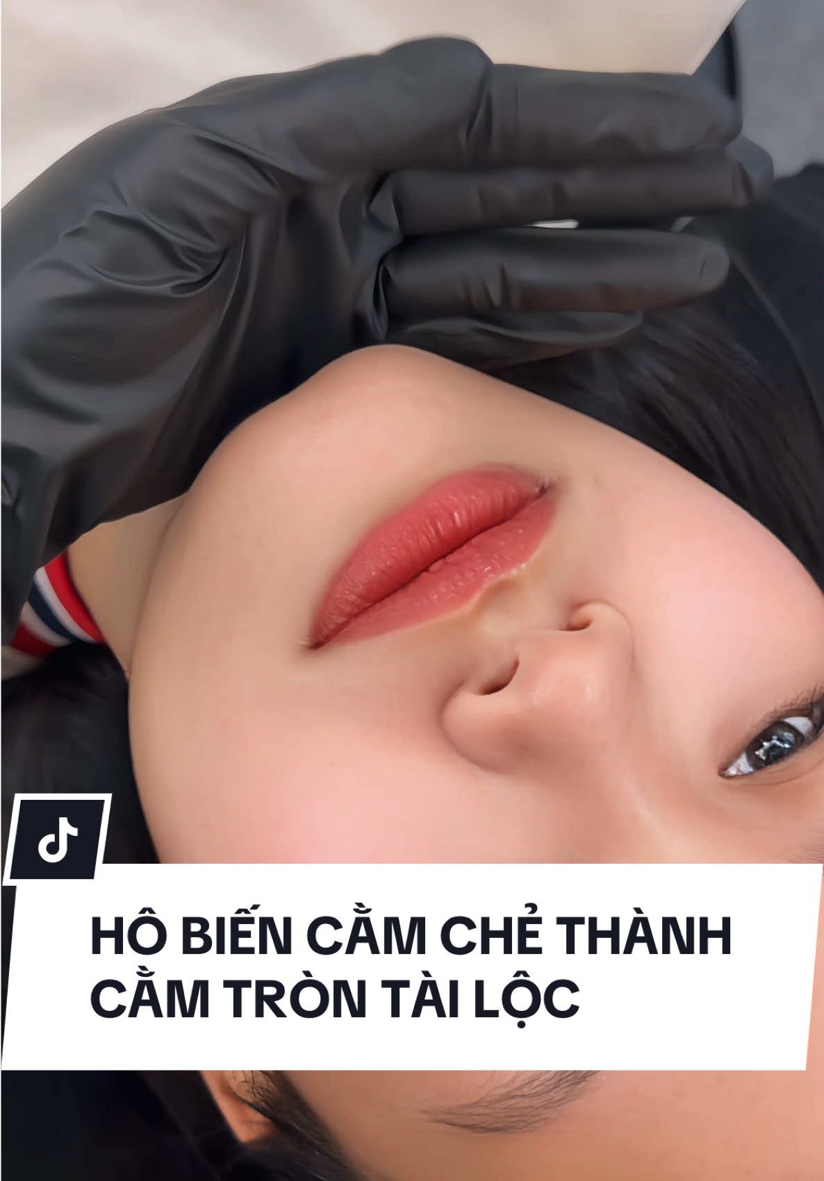 Có những bạn chỉ cần chỉnh đúng chiếc cằm. Chiếc cằm tròn tài lộc này không chỉ giúp mặt thon gọn, cân đối mà còn được xem là nét thu hút tài khí, may mắn đủ đầy nữa đó 😘 Tuii sửa khuyết điểm cho nó trở về như bình thường .. Vẫn giữ được vẻ tự nhiên và nét xinh riêng cho bạn ấy🤭. Chiều lòng được từ những bạn kĩ tính mặt nguyên bản không muốn can thiệp gì luôn đây này 😘😘. #Fullface #canchinhmat #taohinhma #giamthammat #tiemmoidep #moibaby #filler #botox #HAcollagen #meso #cangbongda #candydebeaute #booking #lamdep #moithietke #BAP