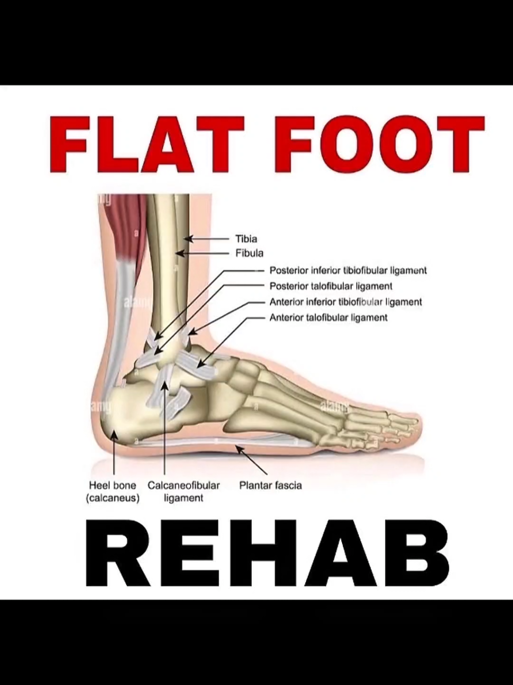 عضلة واحدة… ممكن تبوّظ مشيتك كلها! إنت متخيل إن عضلة صغيرة في الساق اسمها Tibialis Posterior هي اللي بتتحكم في شكل قوس القدم… ولو ضعفت؟ بتكون السبب الأساسي في الفلات فوت (Flat Foot) والتحميل الغلط على الكاحل والركبة والضهر كمان! العضلة دي بتبدأ من الجزء الداخلي لعظمة الساق (Tibia) وبتوصل لأسفل القدم… وظيفتها إنها تثبّت القوس الداخلي للقدم وتحافظ على استقرار الكاحل وقت المشي أو الوقوف أو الجري. 🧠 طيب لما العضلة دي تضعف؟ يحصل Overpronation يعني القدم تفرش لتحت، وده يسبب: – هبوط في قوس القدم – ضغط على المفصل الداخلي للركبة – انحراف في الحوض – تعب مستمر في الكاحل وأسفل الضهر يعني لو بتعاني من: – فلات فوت – ألم في الكاحل – ألم في باطن القدم – أو حتى وجع مزمن في الضهر وأنت واقف كتير ممكن جدًا تكون Tibialis Posterior هي السبب الحقيقي! ✅ الحل مش تقوية العضلة بس! – لازم نفك الشد اللي حاصل حوالين الكاحل أولًا – نفعّل العضلة في الزاوية الصح – ندرّب الجسم على المشي والتوازن من جديد وده اللي بنشتغل عليه في خطة تأهيل شاملة ومخصصة لحالتك. 🎯 افتكر: لو أهملت العضلة دي، جسمك كله هيبدأ يعوّض… والمشكلة هتكبر من القدم لحد الضهر! 📌 ملاحظة: الفيديو ده جزء من خطة علاجية وتأهيلية متكاملة ولا يُغني عن استشارة الطبيب أو الأخصائي، خصوصًا لو في ألم مزمن أو إصابة. تابعنا لو عايز تفهم جسمك صح 💪 وساعد غيرك بالشير… في ناس فاكرة إن المشكلة في الضهر، بس الحقيقة بدأت من تحت رجليهم! #flatfoot #tibialisposterior #footpain #archsupport #anklepain #posturecorrection #movementtherapy #manualtherapy #rehab #functionaltraining #correctiveexercise #فلات_فوت #اصابات_القدم #تمارين_كاحل #تأهيل_حركي #تمارين_تصحيحية #اصابات_رياضية #العلاج_اليدوي #saudiarabia #الوجه #أملج #saudifitness #ksa #footmobility #ورشة_صيانة_الجسم #أرض_الاستشفاء #recovery_land1 