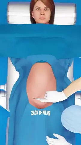 The process of C section #foryoupage #fyp #viral #trending #baby #unfreezemyacount 