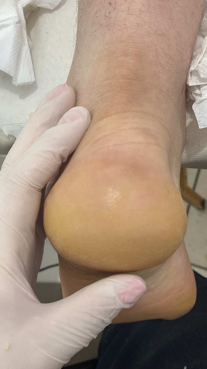 Profilaxia plantar para limpeza dos pés ásperos #fyp #podologarejanepaulabedin ##asmr #asmrvideo #asmrtiktoks 
