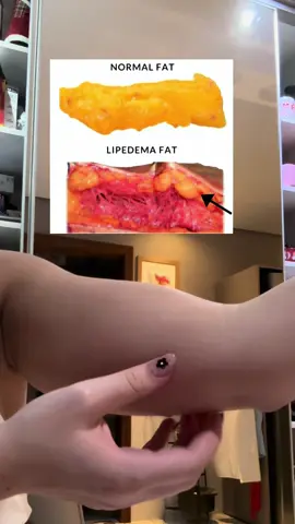É lipedema! Uma gordura em nódulos, com fibrose e dor — diferente da gordura normal e celulite. Mais comum nas pernas, mas eu fui premiada nos braços e pernas 🫠 #lipedema 