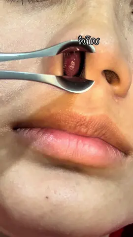 ព្យាបាលដុះសាច់ច្រមុះដោយមិនបាច់វះកាត់ មិនឈឺ មិនហើម មិនបាច់សម្រាកពេទ្យ។