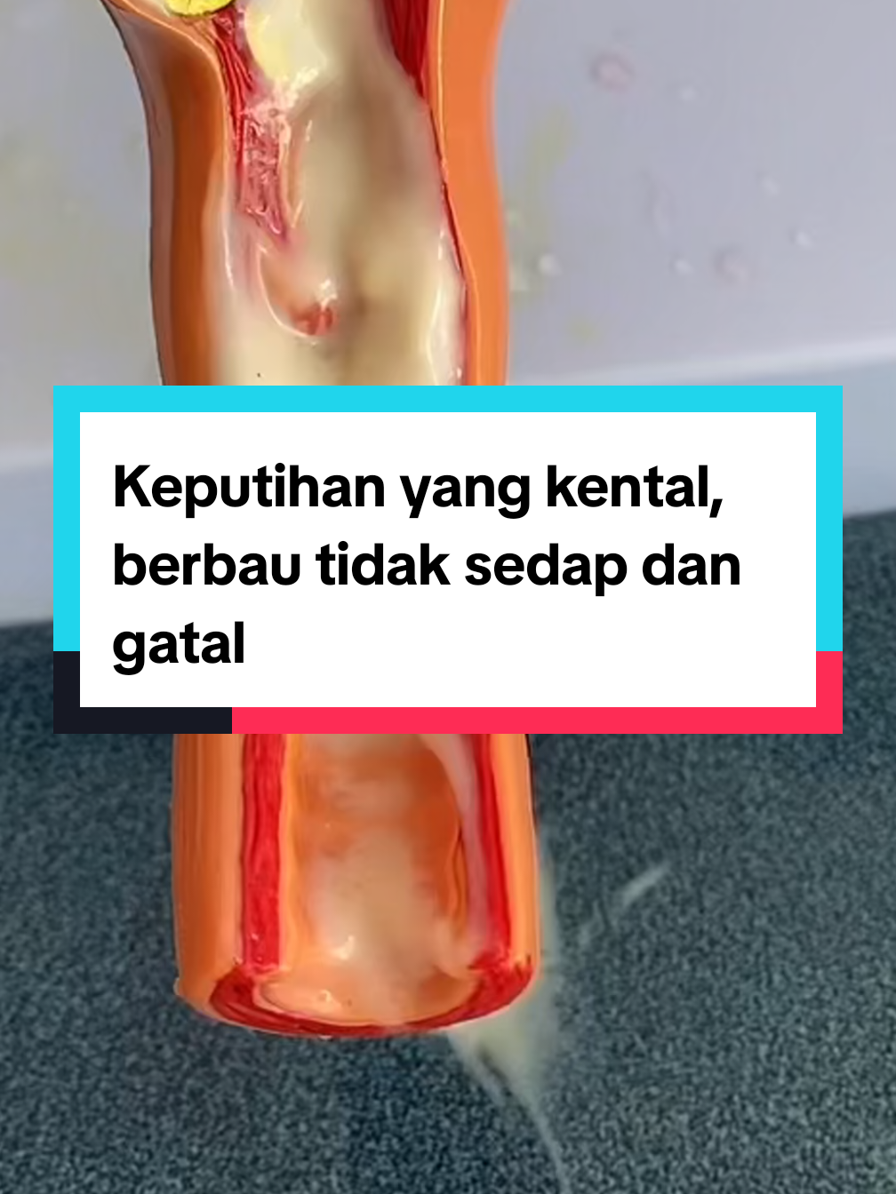 Keputihan yang kental, berbau tidak sedap dan gatal.  #keputihan #keputihanabnormal #keputihangatal #keputihanbau #zymuno 