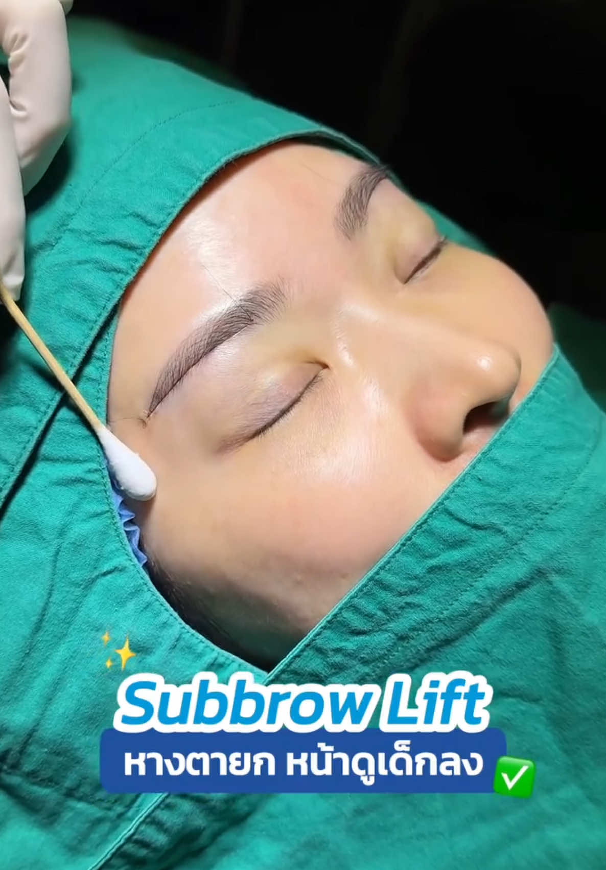 #รีวิวซ่อนแผลใต้คิ้ว แก้หางตาตก หน้่ดูเด็กลงจริงหรอ ⁉️ #subbrowlift #หมอสกาย #จักษุแพทย์ #ศัลยกรรมตา #ซ่อนไหมไร้รอยเข็ม #skyclinic #ทำตาที่ไหนดี 