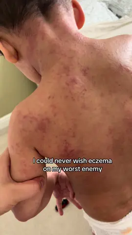 I created this Rescue Cream in the depths of motherhood when nothing else worked. No harsh steroids, no quick fixes, just a natural alternative made with love, from one mother to another 🤍 For the little ones who need something gentle that actually helps 🌿 #eczemaawareness #eczema #eczematok #tsw #topicalsteroidawareness #flareup #babyeczema #eczemarelief #eczemaflareup 