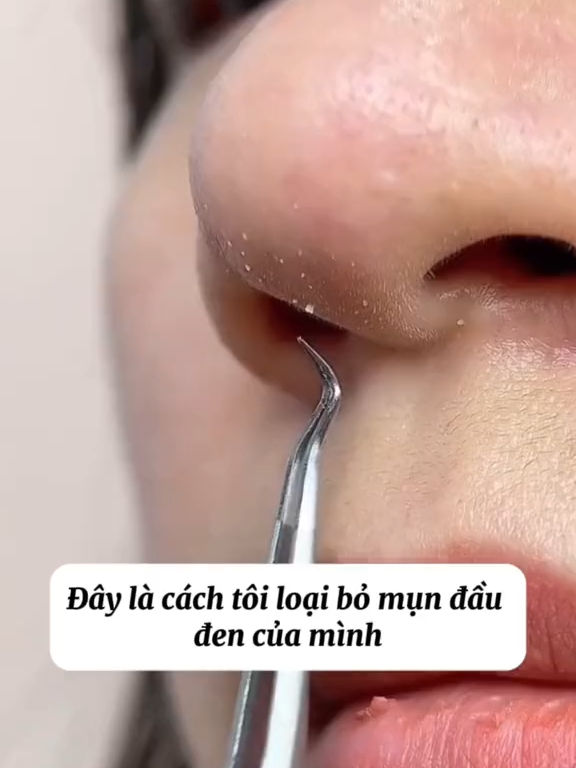 Giảm giá 50% chỉ còn 99k + Tặng 1 Kính phòng to để soi mụn lấy mụn dễ dàng. Bộ 3 món nhíp lấy mụn, chất liệu inox chuyên dụng cho y tế. #nhiplaymun