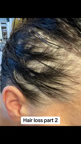 #CapCut #supporters #ladies #hairloss #hairlossjourney #inthistogether #hairlosssolutions #struggle 