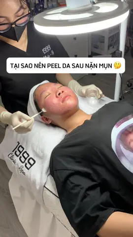 Chemical peel sẽ tiêu điều vi khuẩn acne và giảm sừng giúp da bạn mụn màng hơn ☺️#1999clinic #chamsocdakhoahoc #trimunchuanykhoa #chemicalpeel 