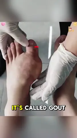 The intense pain of a gout attack can be unbearable. Try our Gout Patch! It deeply penetrates to soothe joint inflammation and relieve the discomfort caused by gout. Simply apply it, and easily manage every gout flare-up, saying goodbye to pain and restoring comfort to your life! 💪🌟#GoutPatch #GoutRelief #JointCare #HealthyLiving #gout #goutpatch #patch#lzj