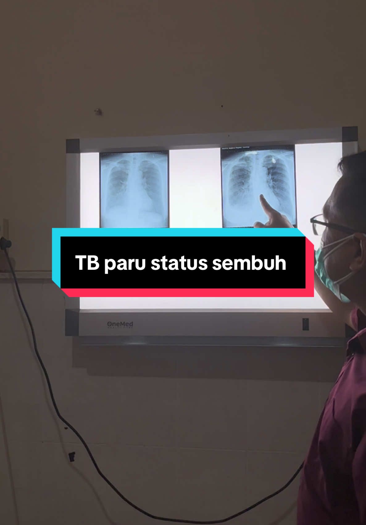 TBC bisa disembuhkan, flek dan cairan paru bisa hilang, dan ini tidak selalu dengan dahak awal pengobatan yg positif loh. Semangat para pejuang TBC, insyaallah kalian sembuh pada waktunya.  #masyaallahtabarakkallah #TB #pleuraleffusion #dr #spesialis #paru #spesialisparu #magetan #madiun24jam #viral #fyp 