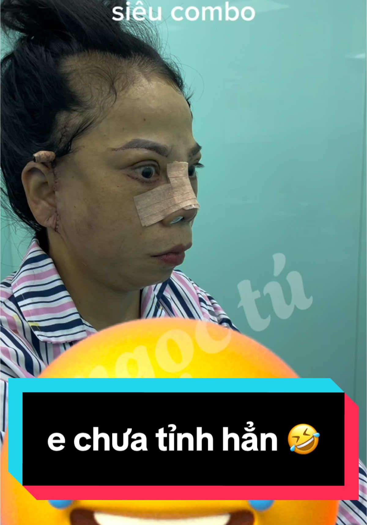 #drngoctuchuyenphauthuatthammy #phẫu_thuật_chỉnh_hình #indonesia🇮🇩 # combo nâng mũi - căng da mặt - nâng cung - cắt mí trên - dưới ✅ 