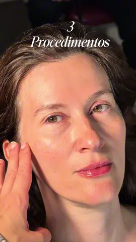 *** TRANSFORMAÇÃO LINDA e MUITO ESPECIAL! Hoje foi dia de cuidar de quem sempre cuidou de mim: minha mãe Foram 3 procedimentos pensados com carinho pra valorizar ainda mais a beleza dela: Sculptra pra estimular o colágeno Botox pra suavizar as marcas de expressão E um toque de preenchimento labial pra realçar o sorriso O resultado tá leve, natural e cheio de amor Me conta aqui: vocês também são do time que AMA cuidar das mães? #HarmonizaçãoFacial #AntesEDepois #Botox #Sculptra #PreenchimentoLabial #MãeLinda #TransformaçãoNatural #EstéticaComAmor #ReelsBrasil