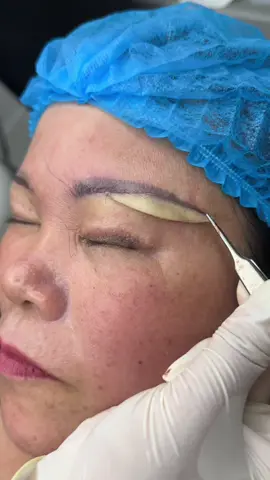 Loại bỏ da dư bằng phương pháp nâng cung chân mày giấu chỉ #nangcung #nangcungmay #nangcungchanmayrutchi #nangcungchanmay #xuhuong 