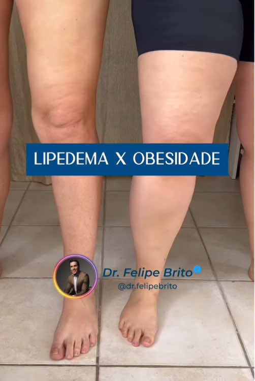 Lipedema não é sobrepeso. É uma doença e precisa ser tratada de forma especializada. ⚠️👇 👨‍⚕️ Apesar de visualmente parecidas em alguns casos, a gordura do Lipedema é diferente da gordura da obesidade ou sobrepeso. O Lipedema é uma condição crônica que causa acúmulo de gordura em regiões específicas do corpo — principalmente pernas e braços — e costuma vir acompanhada de dor, sensibilidade ao toque, inchaço e dificuldade para emagrecer nessas áreas. ✖️Já o acúmulo de gordura por obesidade ou sobrepeso está relacionado ao excesso calórico e costuma ser distribuído de forma mais uniforme pelo corpo. 🔎 A grande diferença é que o Lipedema não melhora apenas com dieta e exercício. Por isso, é comum que pacientes com Lipedema se frustrem ao fazer tudo certo e ainda assim manterem volume nas pernas, joelhos ou braços. ☑️ A boa notícia é que a cirurgia plástica pode ser uma aliada no tratamento. Através da lipoaspiração específica para Lipedema — feita com cuidado para preservar os tecidos e minimizar traumas — conseguimos remover o excesso de gordura, aliviar os sintomas e melhorar a qualidade de vida da paciente. 👉 Se você suspeita que pode ter Lipedema, toque no link da bio e agende sua consulta. O diagnóstico correto é o primeiro passo para tratar com segurança e ter resultados reais. #lipedema #tratamentodelipedema #lipoaspiracaolipedema #cirurgiaplastica #lipedemabrasil #lipedema #cirurgioplasticocampogrande #centrolipedema #fbclinique #drfelipebrito 