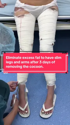 Eliminate excess fat to have slim legs and arms after 3 days of removing the cocoon.#mỡ_bụng #luyến #pttm 