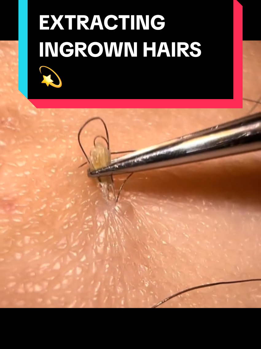 Ingrown hair extraction#creatorsearchinsights #Ingrownhair #ingrowns #ingrown #