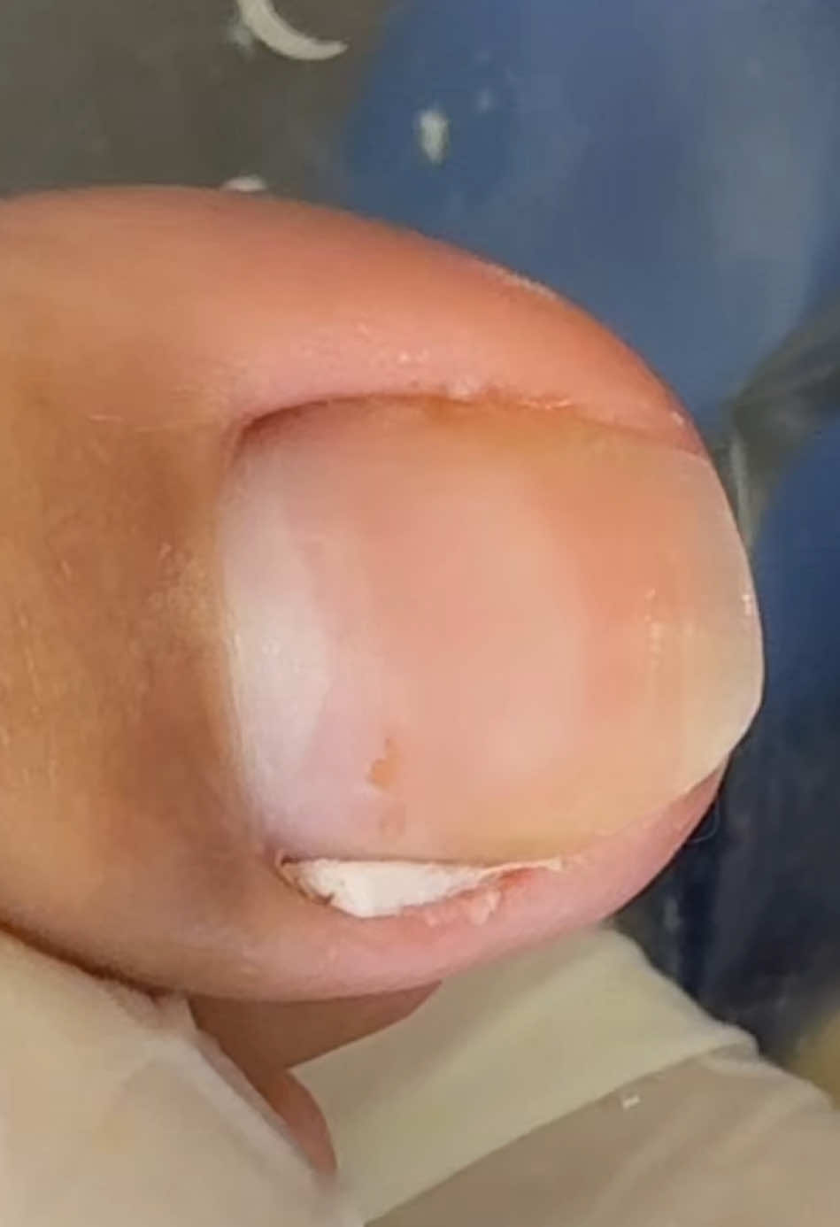 🤤| QUE VÍDEO SATISFATÓRIO ! . #podologia #satisfying #nails #satisfatório #paravocê #fyppage #dormir #fyp 
