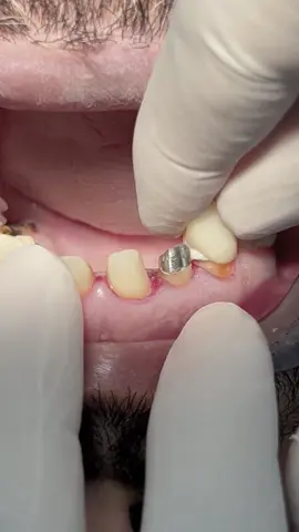Zirconia crowns to protect root canal treated teeth 🦷 #dentist #dental #dentistry 