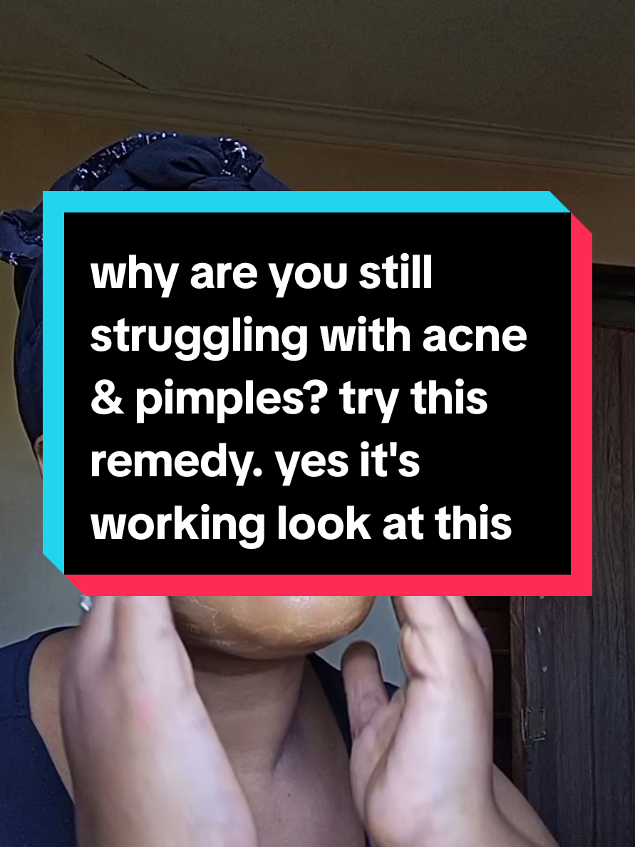 Replying to @sherry.don86  Solution to stubborn pimples, rushes & acne. The remedies are working please give it a try.  #skincaretips  #remedies  #facecare  #floxyd2540 