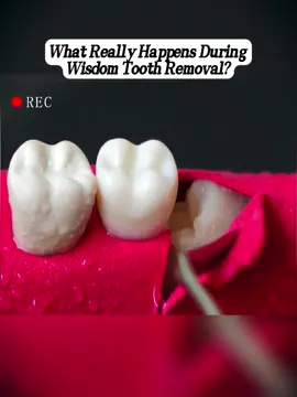 #rootcanal #treatment #tooth #restoration #oral #health