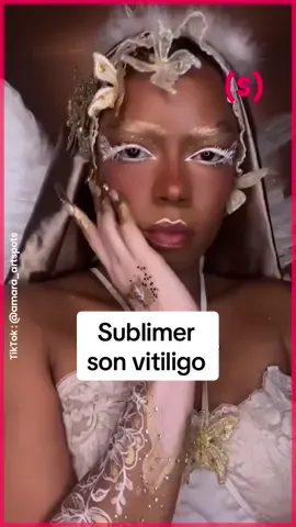 Tout simplement, des œuvres d’art sur la belle œuvre d’art  @amara !  #vitiligo #artist 