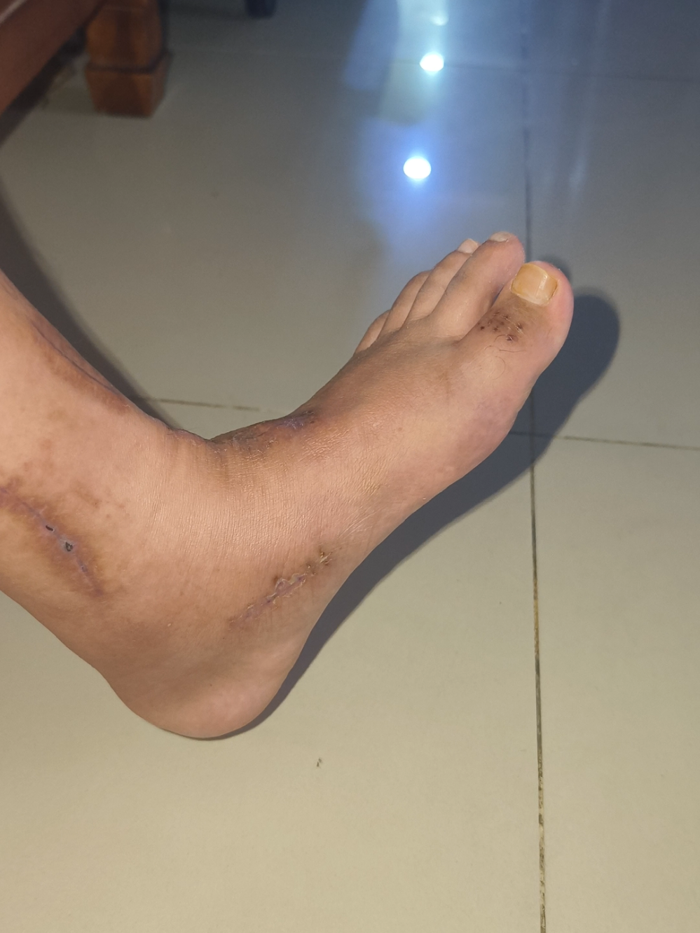 Aku kuat! Aku semangat! Insyaallah aku boleh jalan semula #StrokeSurvivor #StrokeFighter #StrokeRecovery #SpineCordInjury #FootDrop #TendonTransferSurgery #ComeBackStronger 