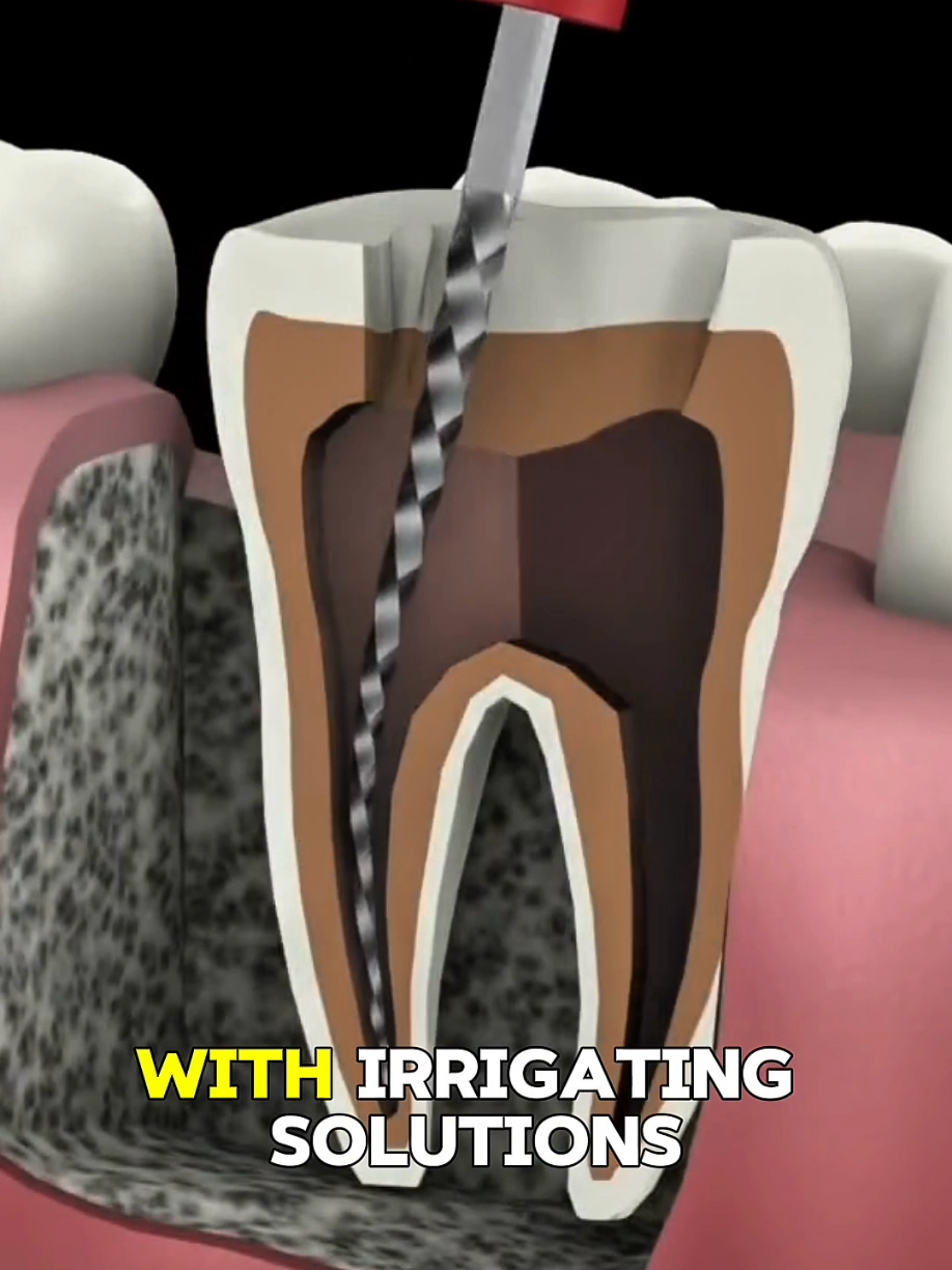 Tooth Pain That Won’t Stop? Here’s How Dental Surgery Brings Instant Relief! 🦷.... #ToothPainRelief #DentalSurgery #RootCanal #ToothExtraction #OralHealth #TikTokHealth #DentistVisit #SmileCare #MedicalExplained #PainFreeSmile