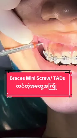 ဒီနေ့တော့ Mini Screw  နှစ်ချောင်းကို စပြီးတပ်ခဲ့ပါပြီ။ မတပ်ခင်ကတော့ အတော်လန့်နေခဲ့သေးပေမဲ့ တကယ် တပ်တဲ့အခါမှတော့ သွားနှုတ်တာလောက်တောင် လန့်စရာမကောင်းခဲ့တာအမှန်ပါ🥺  သွားနှုတ်တုန်းကမှ “ဂျလွတ်ဂျလွတ်”နဲ့ ဆွဲနှုတ်နေတော့ လန့်နေရတာ၊ screw က သွားနှုတ်တာလောက်ကိုတောင် သိကိုမသိရတာပါ။  အခု mini screwတပ်လာပြီးထုံဆေးက ပြယ်သလိုလို မပြယ်သေးသလိုလို အချိန်မှာ ကော်ဖီ၊ ဝက်သားကောက်ညှင်းထုပ်၊ ကင်ချီဟင်းရည်၊ ကြက်ဥပြုတ်တို့ကို ကျွန်မ စားပြီးပါပြီ 😂 Screwကနေ ကြိုးတွေလှမ်းဆွဲထားတော့ နည်းနည်းတော့ သတိထားဝါးနေရသလိုဖြစ်ပေမဲ့ အစာစားပြီးတော့ water flosser လေးနဲ့ပဲ အရင် သန့်ရှင်းရေးလုပ်လိုက်ပါတယ် 🤫 water flosserကို စစချင်းတုန်းက မသုံးတတ်လို့ ရေပန်းတွေ မျက်နှာတက်စင်တာကတော့ တကယ်အမှတ်တရပဲ😂 Braces တပ်ထားတဲ့သူတွေအတွက်က water flosserက တကယ်အသက်ပါ၊ အစကတော့ water flosserစျေးကြီးတယ် အဲ့တာကြီးမလိုလောက်ပါဘူးဆိုပြီး မသုံးဘဲနေခဲ့တာ၊ စျေးကြီးတယ်ဆိုတာ အကြောင်းမဲ့စျေးကြီးတာမဟုတ်ဘဲ။ တကယ်သုံးရတာအဆင်ပြေနေတာ၊ နောက်အပတ်မှ သုံးနည်း videoနဲ့ water flosser ဘယ် brand အဆင်ပြေလဲဆိုတာ တင်ပေးမယ်နော်။  အခုတော့စာစီနေရင်း ထုံဆေးလည်း ပြယ်နေပြီမို့ ကြိုးတွေလည်း လဲထား၊ power chainလည်း တပ်လာတာဆိုတော့ သွားတွေ နာတာ ရွေ့တာလေးတွေ ခံစားမိနေပြီ 🫶🏻😆 နာနေတာကိုက စိတ်ကျေနပ်နေတာ၊ လှလာတော့မယ် ညီလာတော့မယ်ဆိုပြီး။  #fyp #bracescheck #bracesjourney #သွားညှိကုသခြင်း #dentalcare #သွားညှိခြင်း #bracesglassesgirl #miniscrew #bracesscrew #bracestads #bracesguide #braces #waterflosser #bracesexperience #myanmartiktok🇲🇲🇲🇲 #fypシ #fypage #fyppppppppppppppppppppppp #creatorsearchinsights  