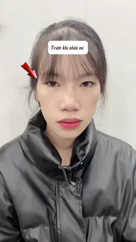 Nhấn mí cho bé khách Đà Lạt 