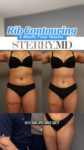 THREE MONTHS post-rib contouring and this transformation speaks for itself. She’s lost 5 inches off her waist—and she couldn’t be happier. Just in time for summer ☀️👙 #RibContouring #SummerReady #WaistSnatched #drsterry #ribcontouring #ribbending #ribxcar #plasticsurgerywithpurpose #plasticsurgerynyc #bodycontouring #invisarib #results 