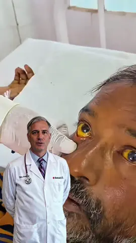⚠️ Alerta importante para sua saúde! Esse paciente chegou ao hospital com sintomas graves: olhos amarelados, inchaço e líquido no abdômen. Tudo isso começou com gordura no fígado, que foi ignorada por tempo demais. O líquido que você vê sendo retirado não resolve a causa, só alivia os sintomas. Não espere chegar a esse ponto. Cuidar do seu fígado agora pode evitar muita dor no futuro. ✅ Quer saber como proteger seu fígado? Comente EU QUERO e clique no link do meu perfil. ⸻ #saude #figado #gorduranofigado #alertasaude #prevencao #cuidadoscomasaude #vidasaudavel #alertamedico #protocolofigado #perigoreal #SaúdeDoCorpo #DoençasSilenciosas #RotinaSaudável #SaúdeNatural 
