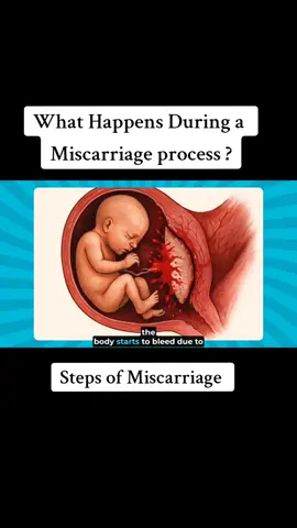 What Happens during a miscarriage process? #MiscarriageAwareness  #PregnancyLoss #miscarriageprocedure  #MiscarriageSupport  #GriefAfterLoss  #WomenSupportingWomen  #MiscarriageJourney  #HealingAfterLoss  #PregnancyLossAwareness  #MiscarriageRecovery  #supportafterloss 