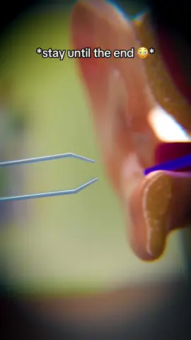 I can’t believe this was in my hole!! 😱  #earwax #earwaxremoval #qtips #pimplepopper #satisfying #viral #TikTokShop #flashsale #fyp 
