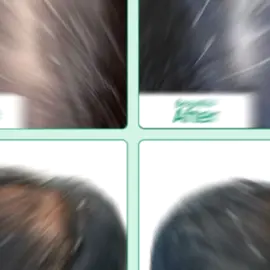 🌿 ROSEMARY HAIR OIL – 100% Natural Solution for Hair Growth & Hair Fall Control! ✅ Boosts Hair Growth ✅ Stops Hair Fall ✅ Strengthens Hair Roots ✅ Relieves Stress ✅ Feel the Difference in 7 Days! 🚚 FREE Delivery Within 2 Days 💵 Cash on Delivery Available 📲 Order Now on WhatsApp: 077 960 1769  #creatorsearchinsights #hairoil #rosemaryoil #hairgrowth #tumeric #tumerigal #calm #tumericrelax #mindrelax #srilanka #foryou #foryoupage 