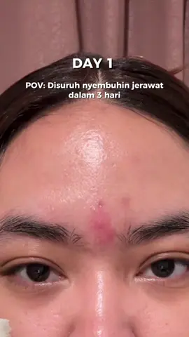 best affordable acne lotion 🤙🏻 #obattotoljerawatg2g #obattotolviral 