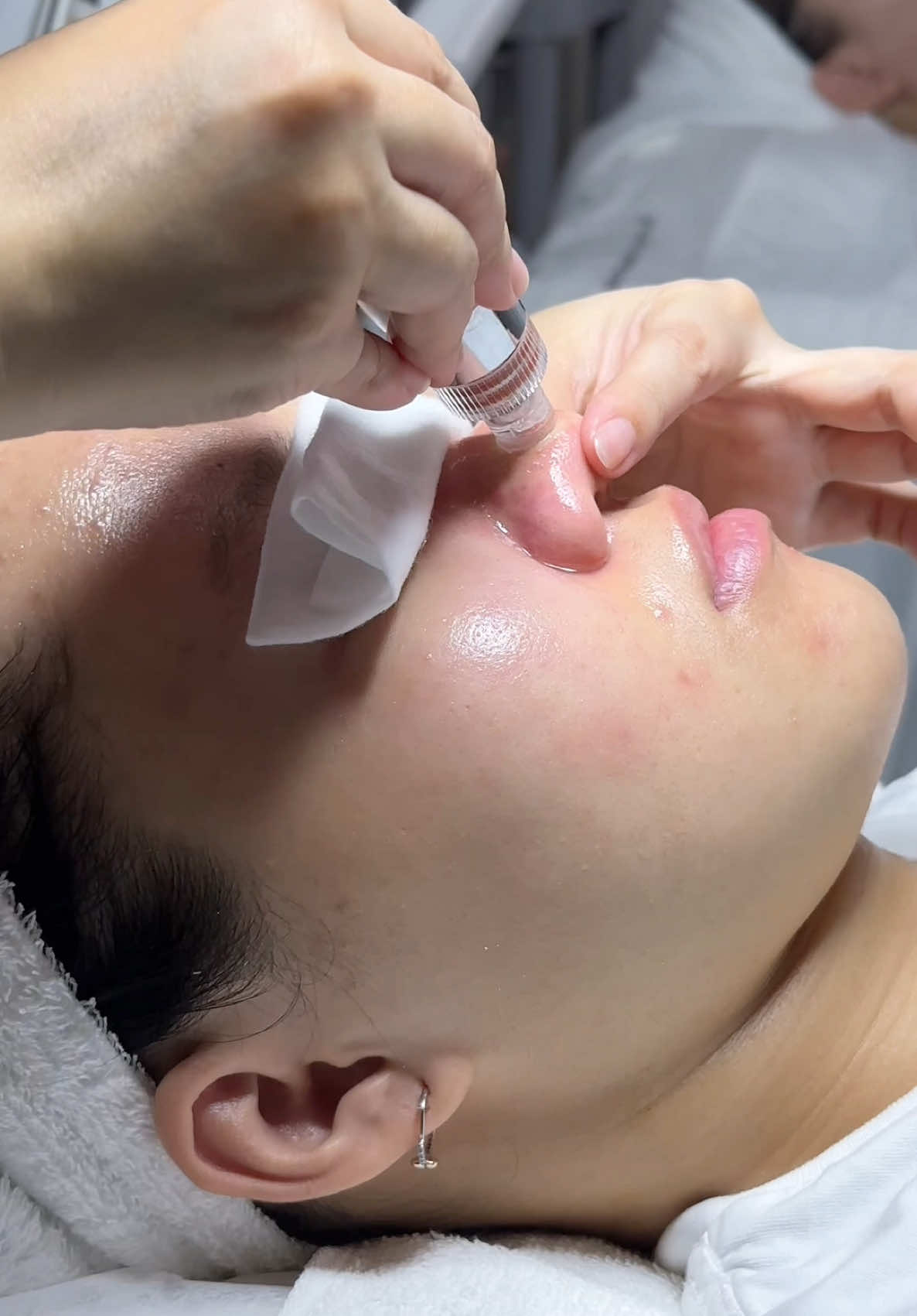 Aqua Peel sử dụng áp lực nước kết hợp với dung dịch AHA và BHA chuyên dụng để xử lí lỗ chân lông, làm sạch và lấy đi các chất bẩn, dầu thừa, các vi sinh vật có hại cho làn da mà không có bất cứ xâm lấn nào. Với các lợi ích mang lại: 👉Se khít lỗ chân lông 👉Tẩy sạch da chết, lớp sừng trên bề mặt da nhanh chóng. 👉Làm da sáng mịn tức thì 👉Hạn chế tình trạng dầu thừa trên da #spaquan11 #duocmypham #reelsvideoシ #princessskincarespa #ChămDaChuẩnYKhoa #skinsciencespa #peelda #SkinCareWithHeart