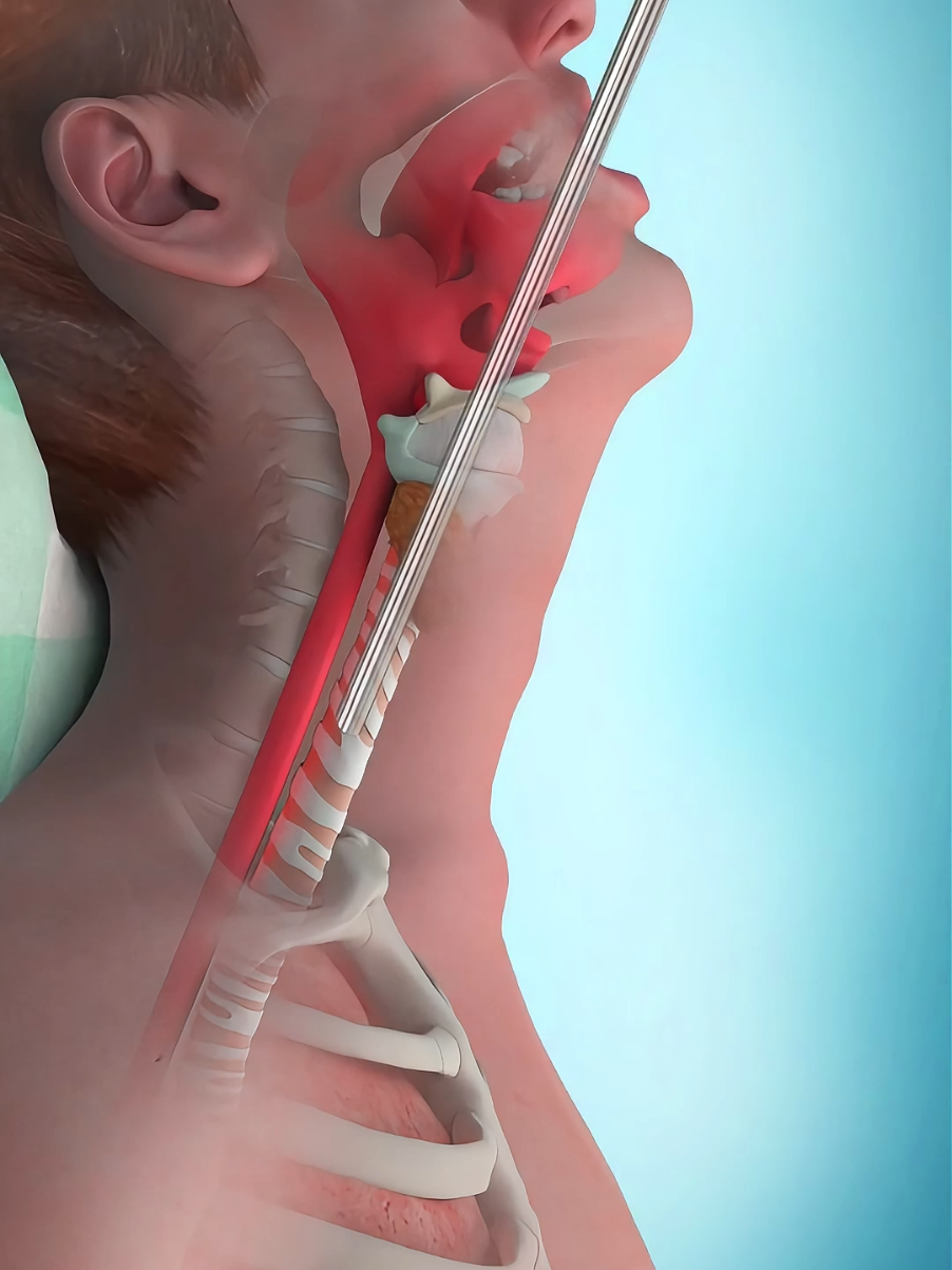 How Bronchoscopy Surgery Is Performed (3D Animation) #3dmedicalanimation  #medical3danimation  #bronchoscopy  #bronchoscopysurgery  #flexiblebronchoscopy  #bronchoalveolarwashing 