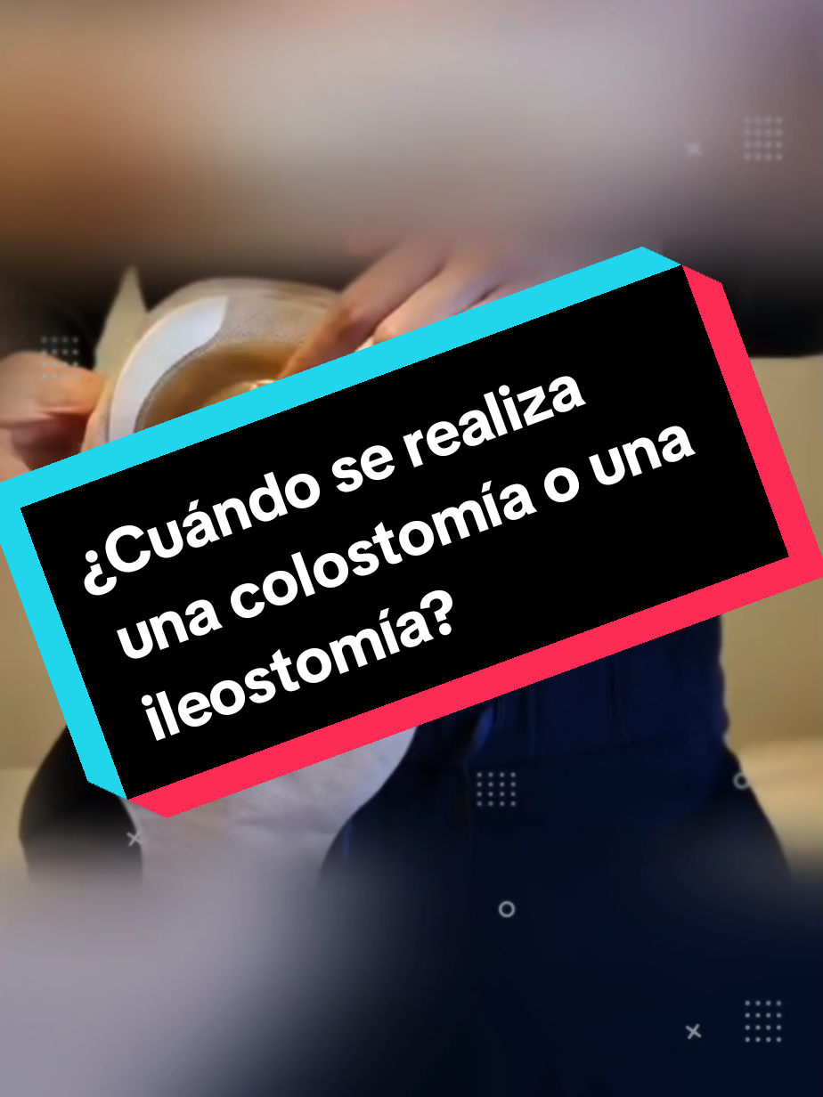 🩺 ¿𝗡𝗲𝗰𝗲𝘀𝗶𝘁𝗮𝘀 𝘂𝗻𝗮 𝟭𝗹𝟯𝟬𝘀𝘁𝟬𝗺𝟭𝟰 𝗼 𝗰𝟬𝗹𝟬𝘀𝘁𝟬𝗺𝟭𝟰? ¡Hazlo con un especialista! Este tipo de procedimientos requiere experiencia, seguimiento y cuidados adecuados. 👨‍⚕️ El Dr. Mendoza es profesional en colopr0ctología y te acompaña en todo el proceso, desde la valoración hasta la recuperación. ✅ Agenda tu consulta ✅ Resuelve tus dudas ✅ Cuida tu salud 1ntestin4l 𝐑𝐞𝐬𝐞𝐫𝐯𝐚𝐫 𝐂𝐢𝐭𝐚: 📲72556006 Clic aquí para WhatsApp🟢💬: https://wa.link/4aw96d 📲 63571333 ¿𝐐𝐮𝐢𝐞𝐫𝐞𝐬 𝐦á𝐬 𝐢𝐧𝐟𝐨𝐫𝐦𝐚𝐜𝐢ó𝐧?  Sígueme en mi Cuenta de Tik Tok: https://www.tiktok.com/@dr.reynaldomendoza... #colostomia #ileostomia #drmendoza #coloproctologo #santacruzdelasierra🇳🇬 #colostomiapermanente #bolsadecolostomia #bolivia🇧🇴 #paratii #fypシ゚ 