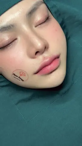 Combo cắt môi nhấn nhân trung cho em gái siu dễ thương 😜 #cắtmôidày #nhấnmi #nhấnnhantrung 