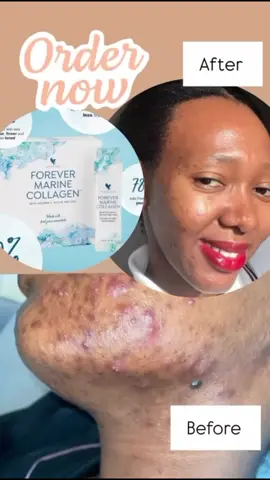 Glow from the inside out ✨ Your skin deserves the best care — and that starts with Forever Marine Collagen. Boosts skin elasticity, reduces fine lines, and supports a youthful glow 🌊💧. One sachet a day, and your skin will thank you! 💙  #GlowWithForever #MarineCollagenMagic #creatorsearchinsights 