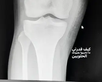 الـركبـه 💔😓 #هاشتاق #كره_القدم #كره_القدم_قصه_عشق_لاينتهي🤩 #المدرسه #كريستيانو_رونالدو #CapCut #viral #typ #تيم_fbi⚡ #تيم_ملوك_العالم #استوريات #استوريات_انستا_واتساب #تصاميم_فيديوهات🎵🎤🎬 #تصميمي #ولد #المدينه #تصويري_احترافي_الاجواء👌🏻🕊😴 #ايام_زمان #الروسي🇷🇺🔥 #الشعب_الصيني_ماله_حل😂😂 #اصابات_الركبه #اصابات_كرة_القدم 