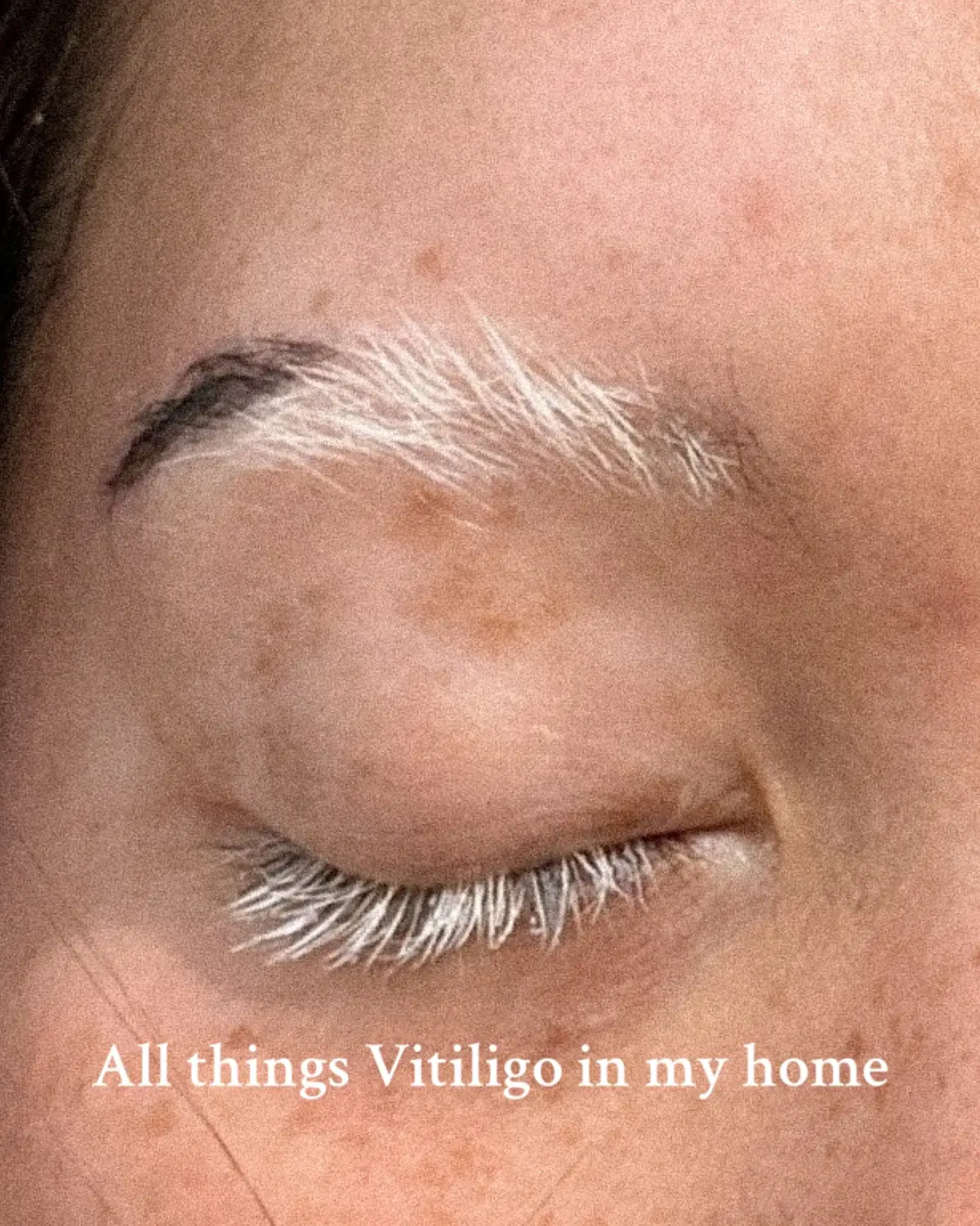 I’m celebrating not just my skin, but all the growth, strength, and self-love this journey has brought into my life. I didn’t choose vitiligo, but I chose to turn it into something meaningful. Every touch of it in my home is a reminder that healing is possible, and beauty can be reimagined in the most powerful ways. Happy World Vitiligo Day! 🤍💜 #vitiligo #worldvitiligoday #vitiligoawareness #beautystandards 