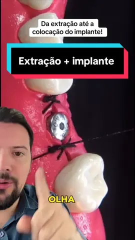 Uma das técnicas de colocação de implante. #boca #dente #implante #sorriso #dentista 