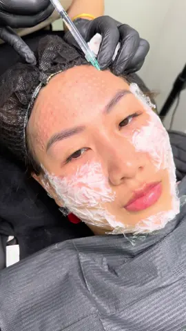 Meso đi các người đẹp vẫn sale 10% dịch vụ filler botox ạ