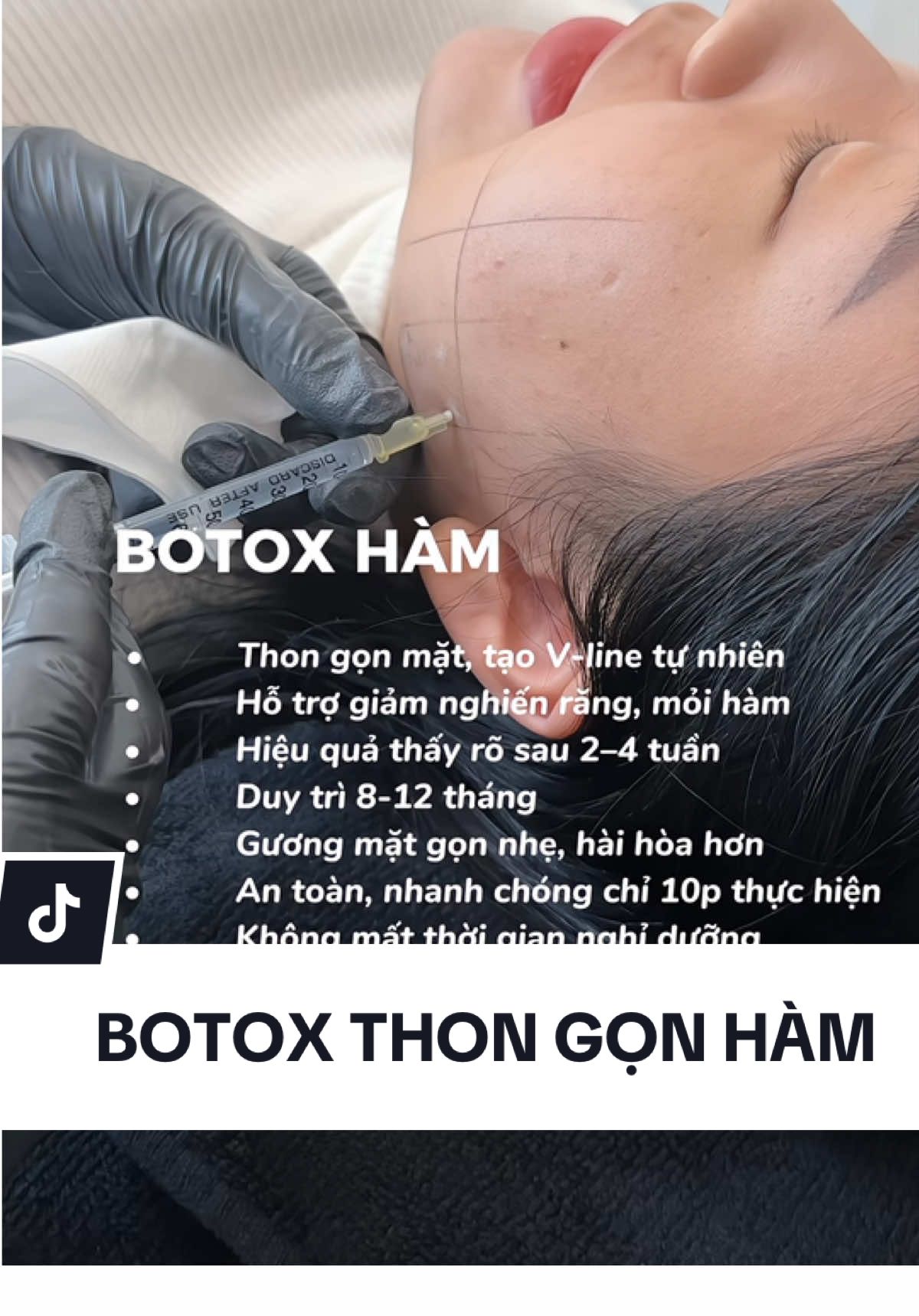 Cứu tinh cho mấy bạn mặt to hàm to muốn Vline hơn nè #fillerdanang #botoxdanang #botoxhamdanang #phuongtodebeauté 