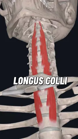 Longus colli is a paired muscle located on the anterior aspect of the vertebral column. As such, it is often referred to as an anterior prevertebral muscle together with longus capitis, rectus capitis anterior and scalenus anterior muscles. The longus colli muscle (‘long muscle of the neck’) is also known as longus cervicis since it spans the entire cervical spine and the first three thoracic vertebrae. By acting on the cervical vertebrae, longus colli is responsible for forward and lateral flexion of the neck, as well as rotation of the neck.  Origin: Superior part: Anterior tubercles of transverse processes of vertebrae C3-C5 Intermediate part: Anterior surface of bodies of vertebrae C5-T3 Inferior part: Anterior surface of bodies of vertebrae T1-T3 Insertion: Superior part: Anterior tubercle of vertebra C1 Intermediate part: Anterior surface of bodies of vertebrae C2-C4 Inferior part: Anterior tubercles of transverse processes of vertebrae C5-C6 Action: Bilateral contraction: Neck flexion Unilateral contraction: Neck contralateral rotation, neck lateral flexion (ipsilateral) Innervation Anterior rami of spinal nerves C2-C6 Blood supply : Branches of the vertebral, ascending pharyngeal and inferior thyroid arteries #osteopathy #osteopath #anatomy #osteopathyworks #osteopaths #neckpain 