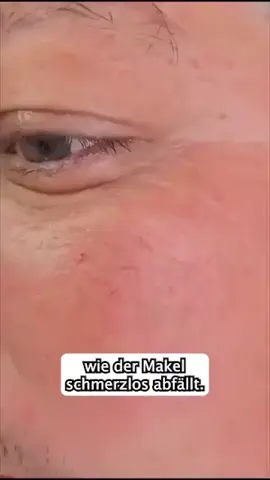 🎯 Genug von lästigen Hautanhängseln? Spar dir teure Laserbehandlungen! Tausende setzen jetzt auf dieses pflanzenbasierte Mikronadel-Pflaster – Hautanhängsel trocknen aus und fallen in nur 3–5 Tagen ab! 🌿 ✨ Ideal für empfindliche Stellen wie Augenlider, Hals oder Achseln. Ganz ohne Schmerzen, Narben oder Ausfallzeiten. ✔️ Pflanzliche Wirkstoffe ✔️ Von Dermatologen getestet & FDA-konform ✔️ Sanft zur Haut – auch bei sensiblen Bereichen ✔️ 9 Pflaster pro Packung – einfach & effektiv 💬 „Hat besser funktioniert als alles, was ich je probiert habe!“ – sagen 96 % der Nutzer 👉 Jetzt tippen & testen – deine Haut wird es dir danken! #Hautpflege#SkinTag#TikTokBeauty#Microneedle