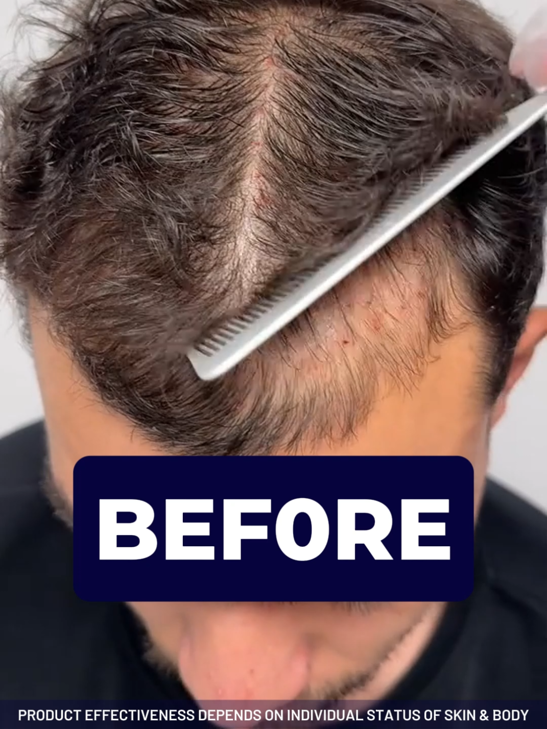 No more hair loss and unconfident with FEG #fegplus #hair #serum #fyp #arab #saudi 