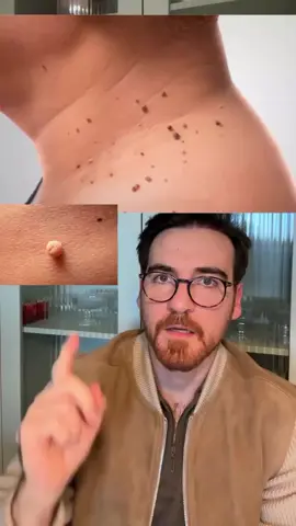 Resistência Insulínica: o que ninguém te conta! Se você tem dificuldade para perder peso, sente muita fome à noite, tem gordura abdominal, pele escurecida no pescoço ou acrocórdons (as “pelinhas” no corpo)… atenção 🚨 Pode ser resistência insulínica — e isso é o primeiro passo para diabetes, gordura no fígado, ovários policísticos, queda de cabelo e até Alzheimer. Mas tem solução 💥 Suplementos que ajudam a reverter a resistência à insulina: 🍃 Berberina – age como metformina natural 🧬 Ácido alfa-lipóico – reduz inflamação e melhora a captação de glicose 💊 Cromo – regula a vontade de doces e melhora sensibilidade à insulina 🧠 Magnésio – essencial para o metabolismo da glicose 🔥 Canela em cápsulas – ajuda no controle glicêmico e picos de insulina 🍎 Vinagre de maçã – reduz o pico glicêmico quando usado antes das refeições 🕒 Dica de ouro: tomar vinagre de maçã diluído em água 15 min antes do almoço e do jantar pode mudar seu metabolismo 🚀Envie para suas amigas e siga esse meu novo perfil